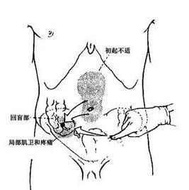 阑尾炎的人体位置图片图片
